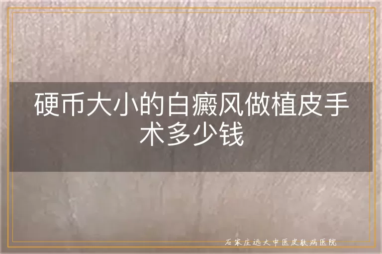 硬币大小的白癜风做植皮手术多少钱