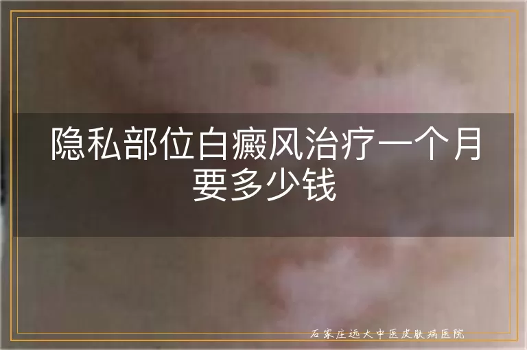 隐私部位白癜风治疗一个月要多少钱
