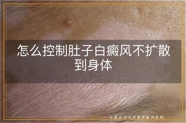 怎么控制肚子白癜风不扩散到身体