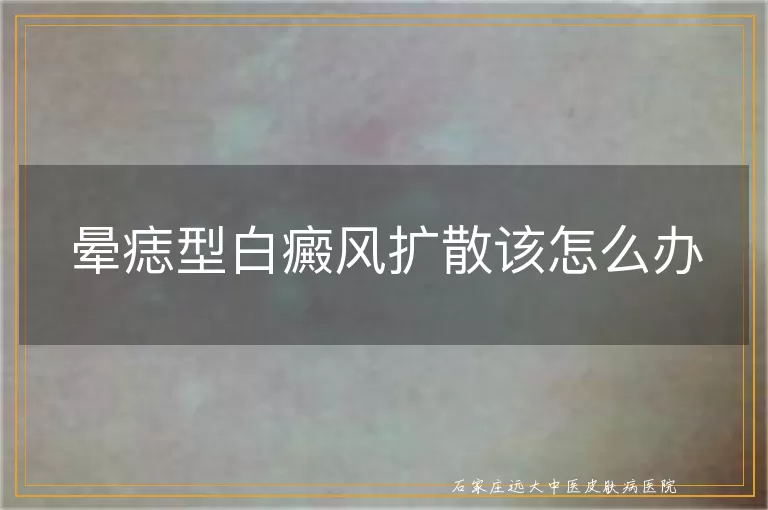 晕痣型白癜风扩散该怎么办
