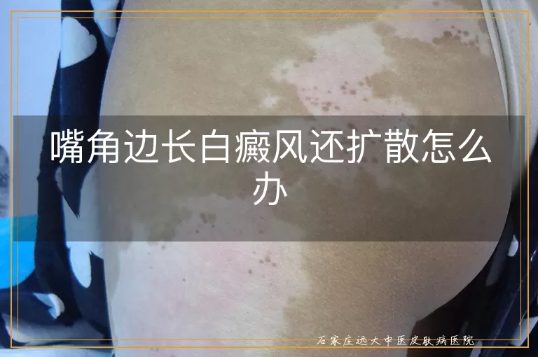 嘴角边长白癜风还扩散怎么办