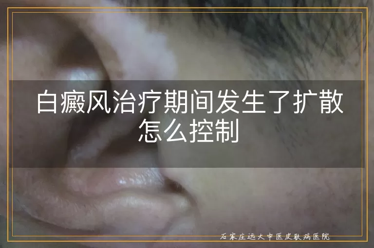 白癜风治疗期间发生了扩散怎么控制