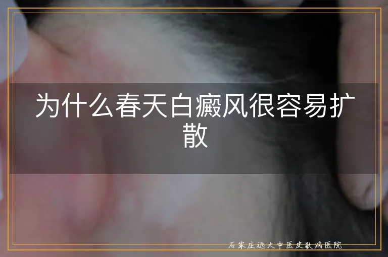 为什么春天白癜风很容易扩散