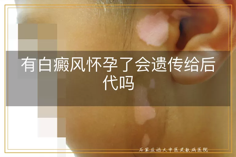 有白癜风怀孕了会遗传给后代吗
