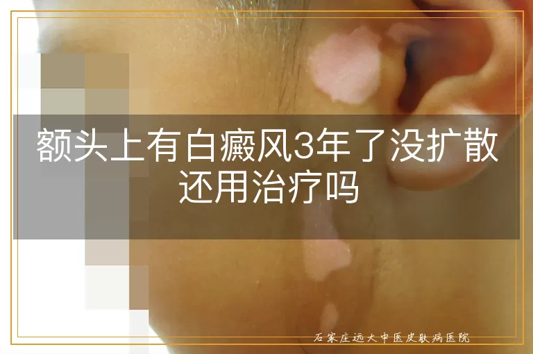 额头上有白癜风3年了没扩散还用治疗吗