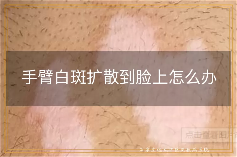 手臂白斑扩散到脸上怎么办
