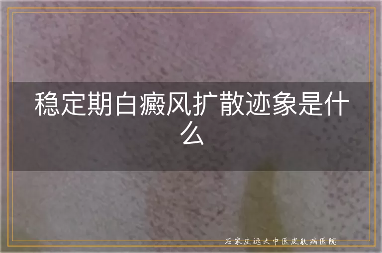 稳定期白癜风扩散迹象是什么