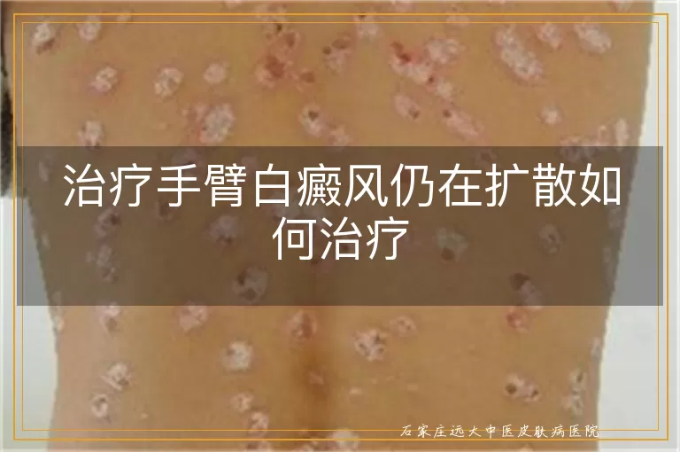 治疗手臂白癜风仍在扩散如何治疗
