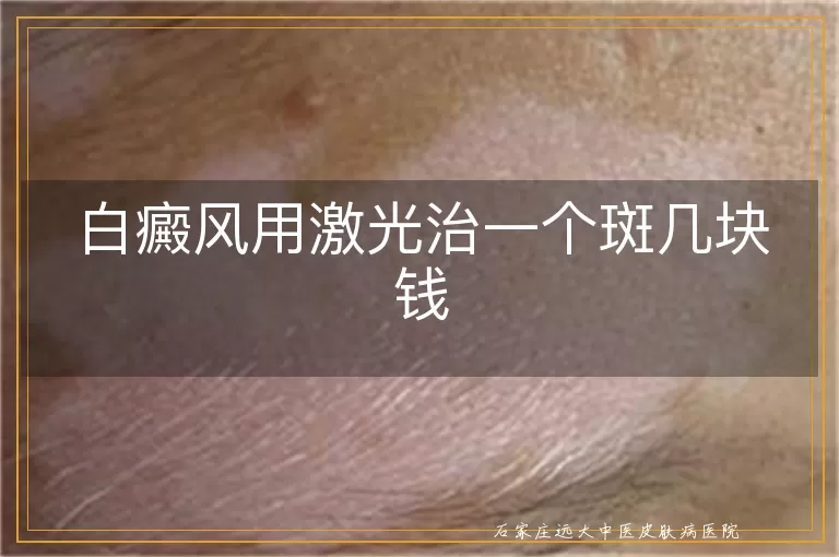 白癜风用激光治一个斑几块钱
