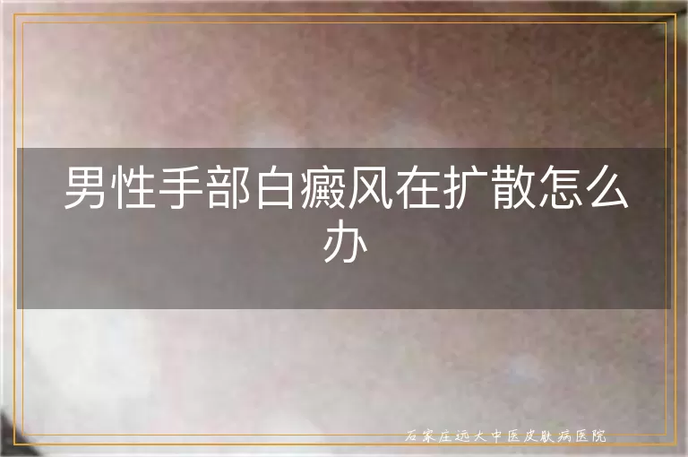 男性手部白癜风在扩散怎么办