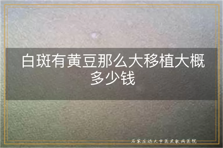 白斑有黄豆那么大移植大概多少钱