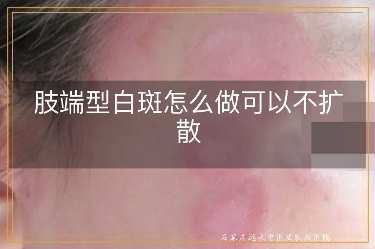 肢端型白斑怎么做可以不扩散