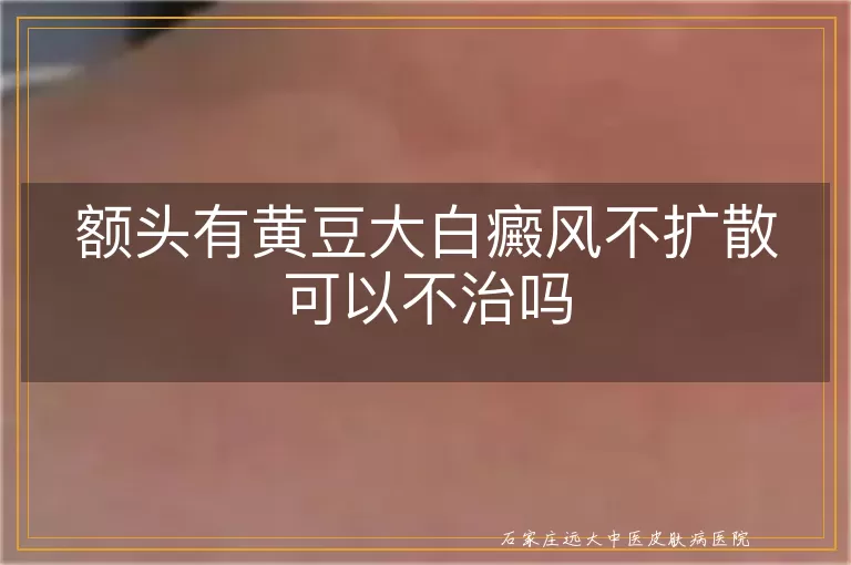 额头有黄豆大白癜风不扩散可以不治吗