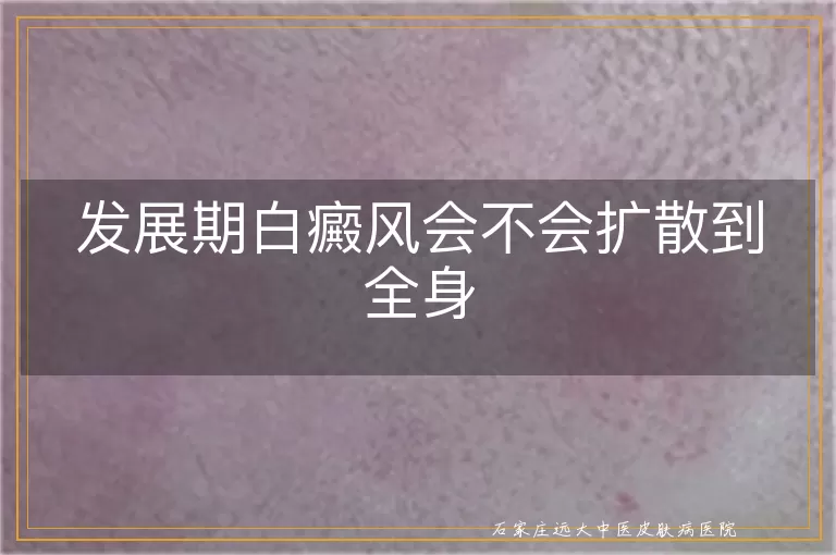 发展期白癜风会不会扩散到全身