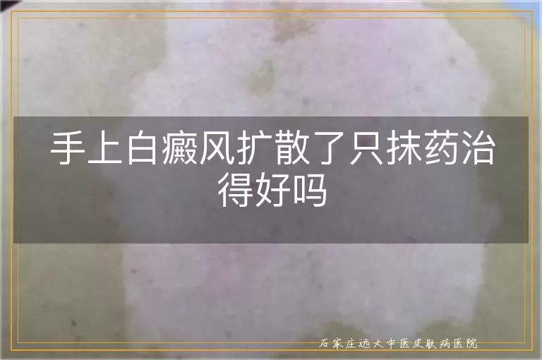 手上白癜风扩散了只抹药治得好吗