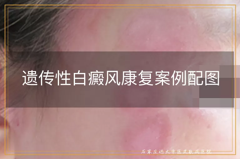 遗传性白癜风康复案例配图