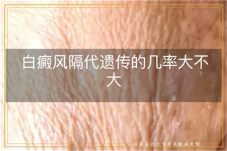 白癜风隔代遗传的几率大不大