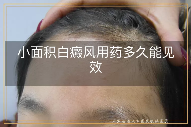 小面积白癜风用药多久能见效