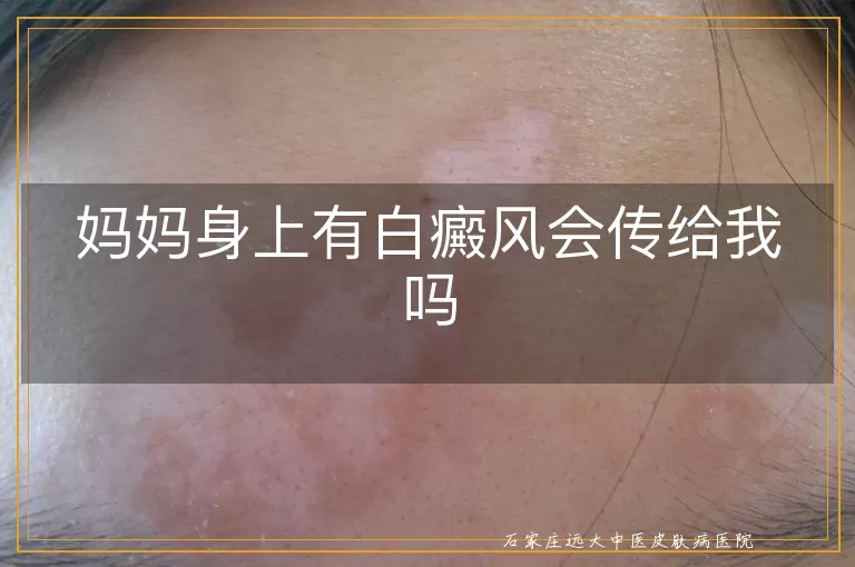 妈妈身上有白癜风会传给我吗