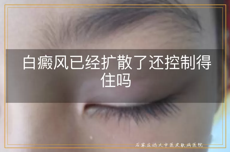 白癜风已经扩散了还控制得住吗