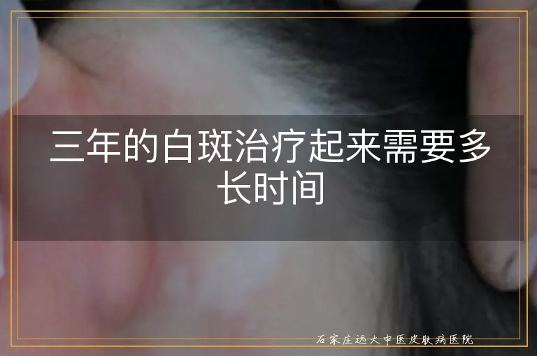三年的白斑治疗起来需要多长时间