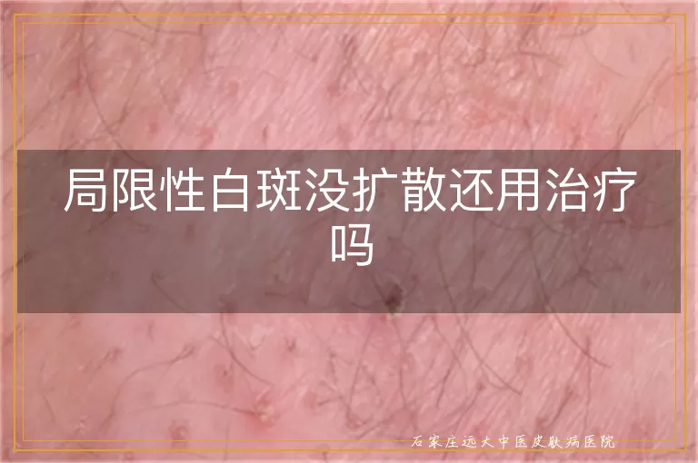 局限性白斑没扩散还用治疗吗