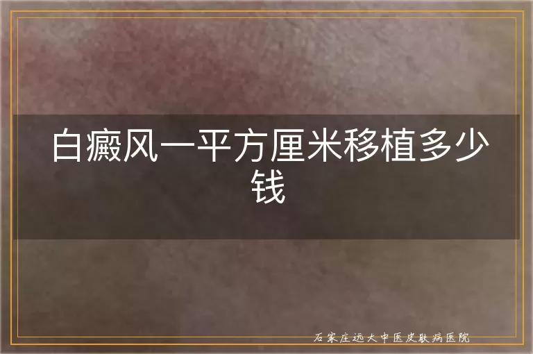 白癜风一平方厘米移植多少钱