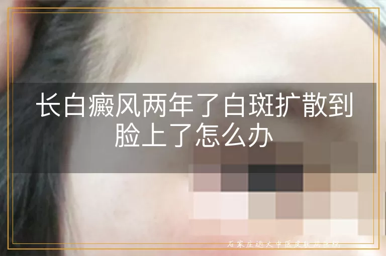 长白癜风两年了白斑扩散到脸上了怎么办