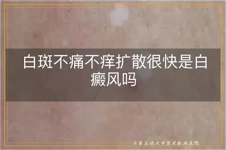 白斑不痛不痒扩散很快是白癜风吗