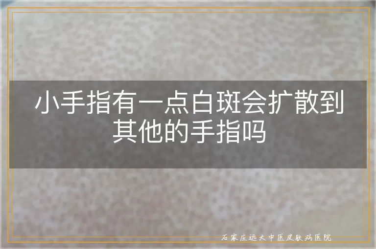 小手指有一点白斑会扩散到其他的手指吗