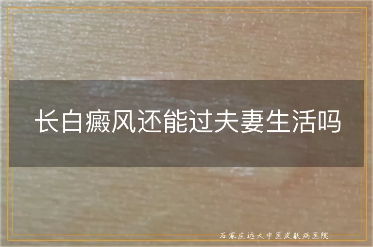 长白癜风还能过夫妻生活吗