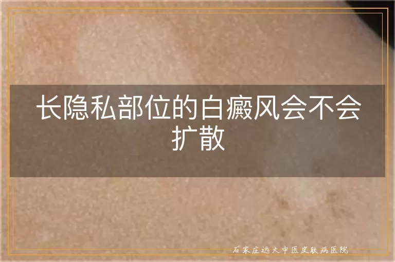 长隐私部位的白癜风会不会扩散