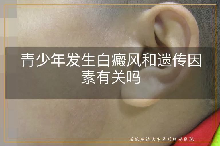 青少年发生白癜风和遗传因素有关吗