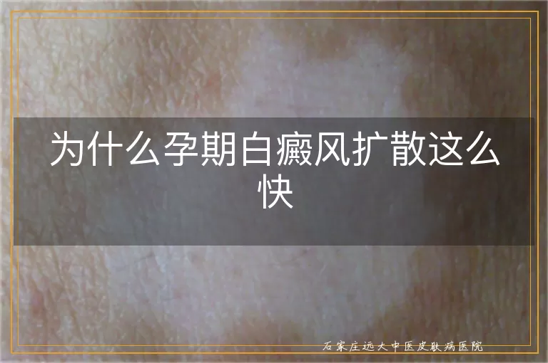 为什么孕期白癜风扩散这么快