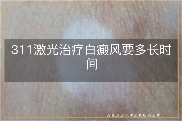 311激光治疗白癜风要多长时间