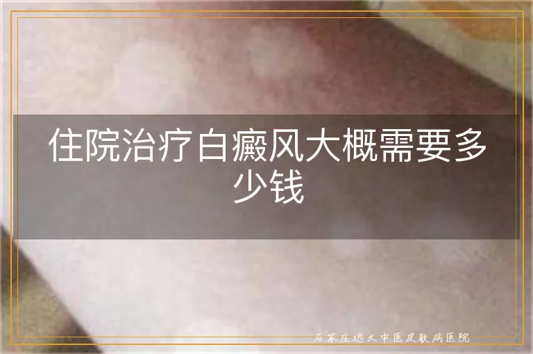 住院治疗白癜风大概需要多少钱