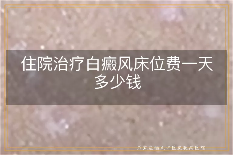 住院治疗白癜风床位费一天多少钱