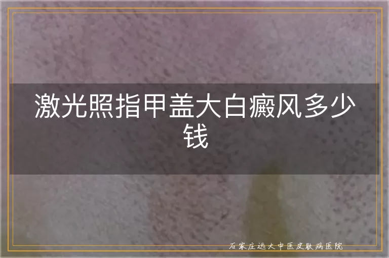 激光照指甲盖大白癜风多少钱