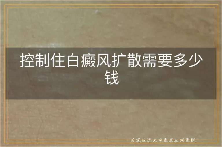 控制住白癜风扩散需要多少钱