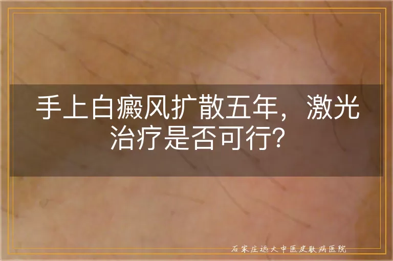 手上白癜风扩散五年，激光治疗是否可行？