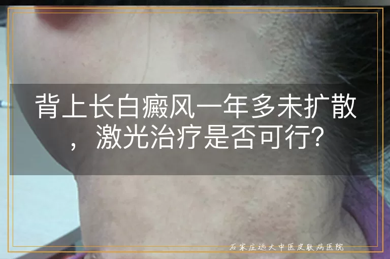背上长白癜风一年多未扩散，激光治疗是否可行？