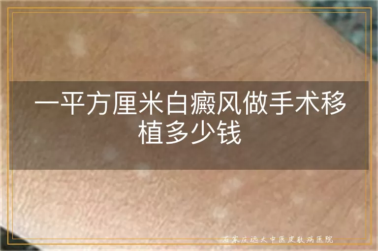 一平方厘米白癜风做手术移植多少钱