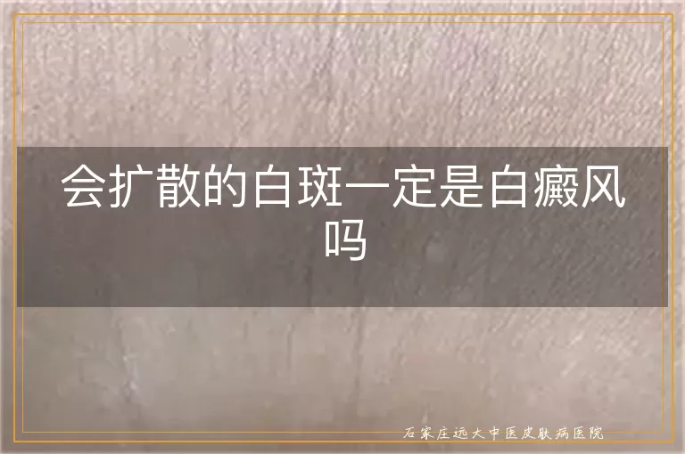 会扩散的白斑一定是白癜风吗