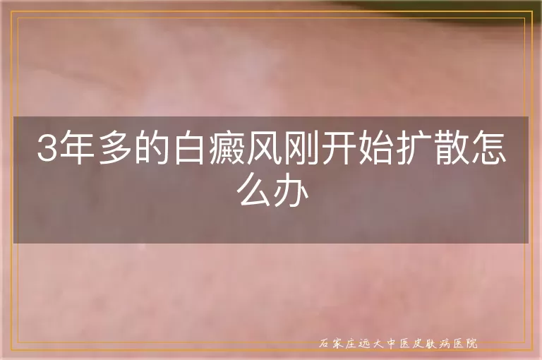 3年多的白癜风刚开始扩散怎么办