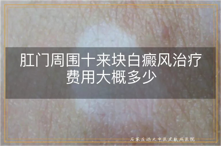 肛门周围十来块白癜风治疗费用大概多少