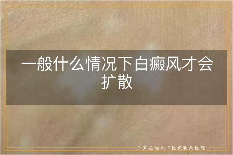一般什么情况下白癜风才会扩散