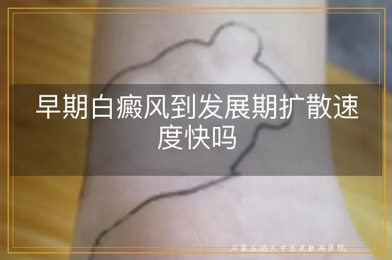 早期白癜风到发展期扩散速度快吗