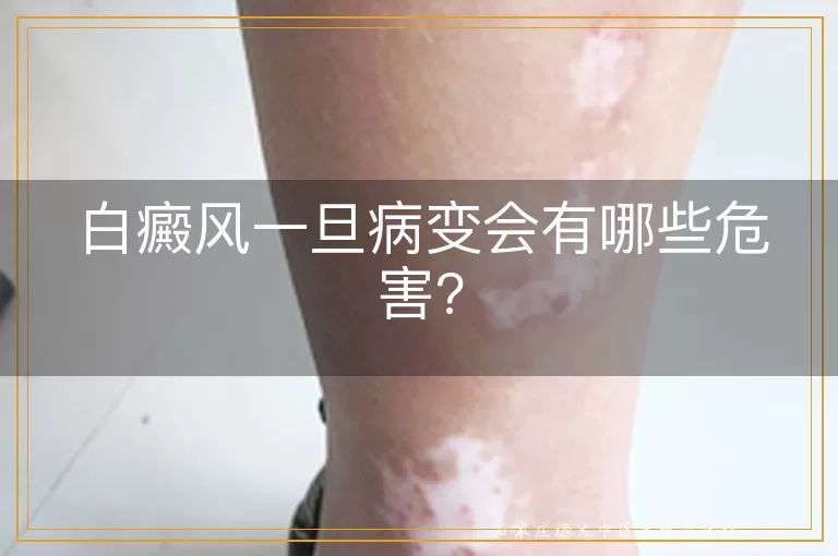 白癜风一旦病变会有哪些危害?