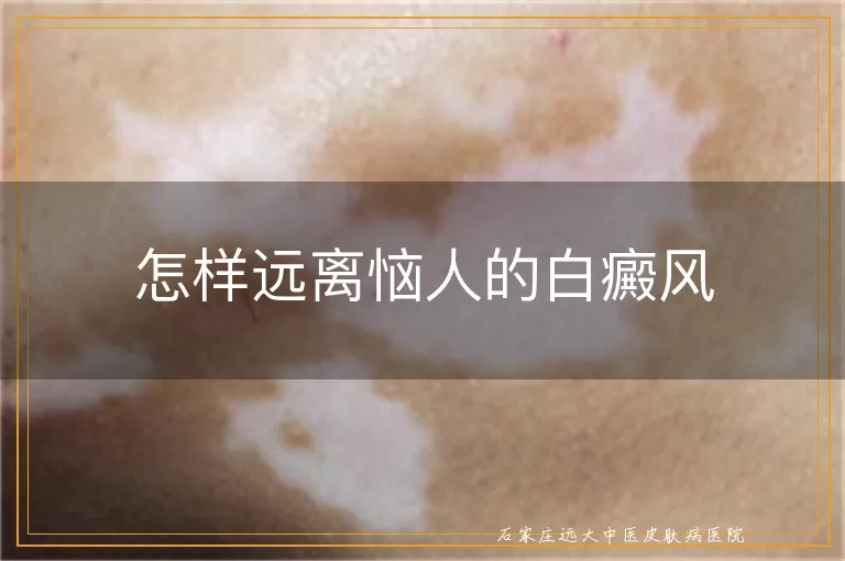 怎样远离恼人的白癜风