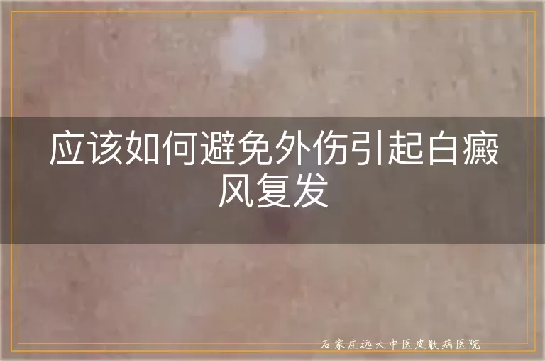 应该如何避免外伤引起白癜风复发